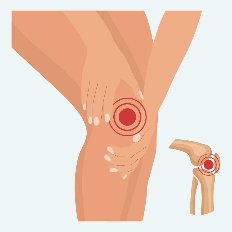 Schmerzen im das Knie gemeinsam, Knie Arthritis, Bein Schmerzen fällig zu rheumatoide Arthritis. Anatomie von Mensch Knochen. Illustration, Vektor