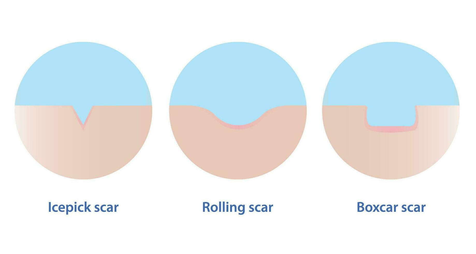 typer av acne ärr vektor ikon uppsättning isolerat på vit bakgrund. korsa sektion av ishacka ärr, rullande ärr och rutbil ärr med hud yta. hud vård och skönhet begrepp illustration.