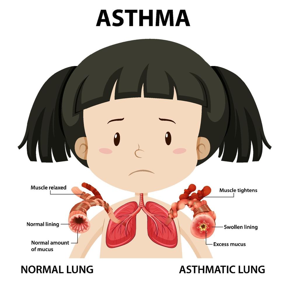 Asthmadiagramm mit normaler Lunge und asthmatischer Lunge vektor