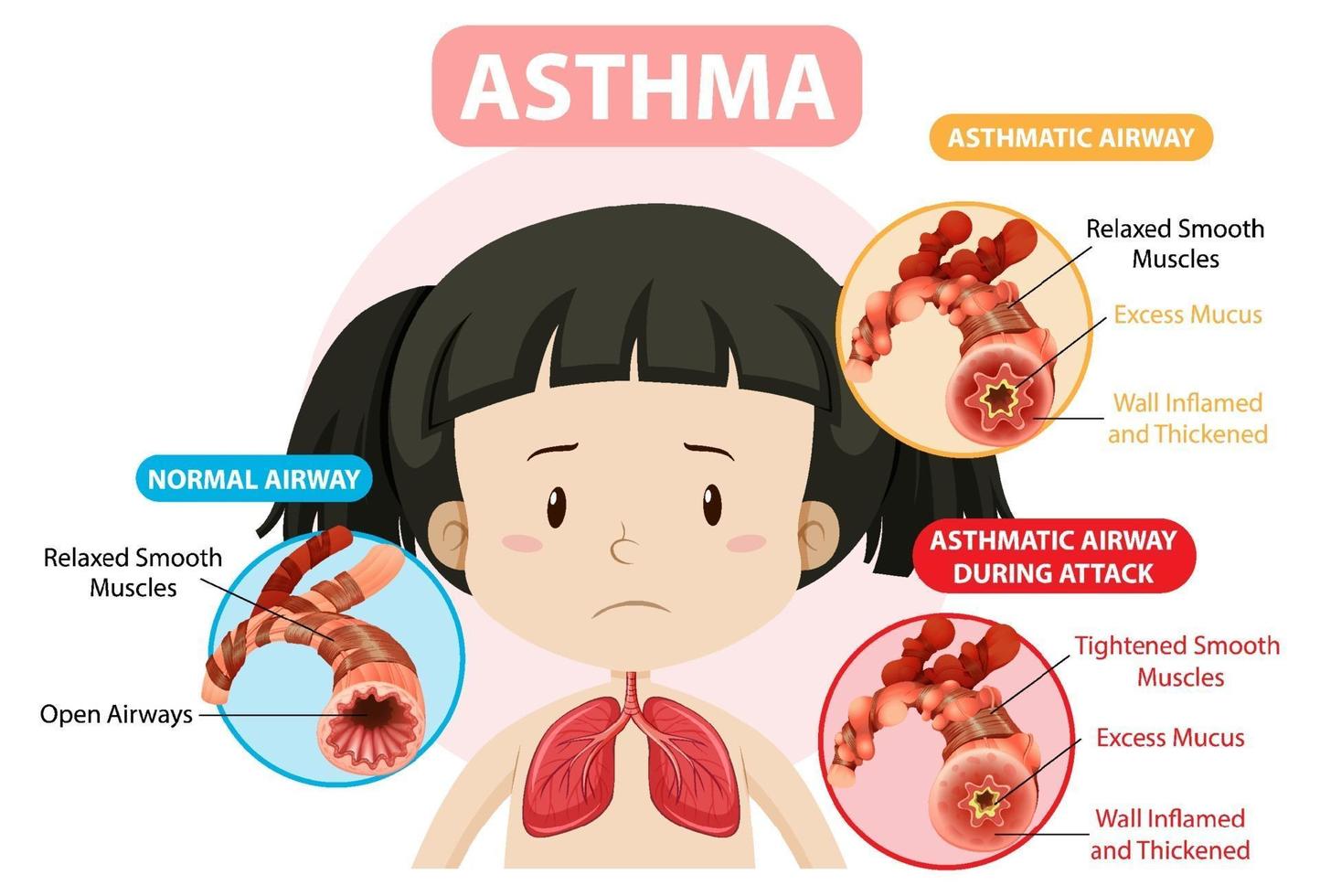 astmaschema med normal luftväg och astmatisk luftväg vektor