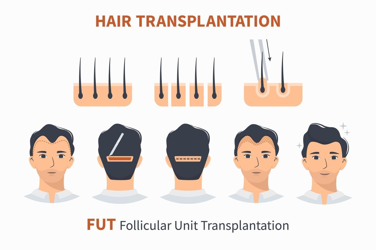 stadier av hårtransplantation fut follikulär enhet vektor