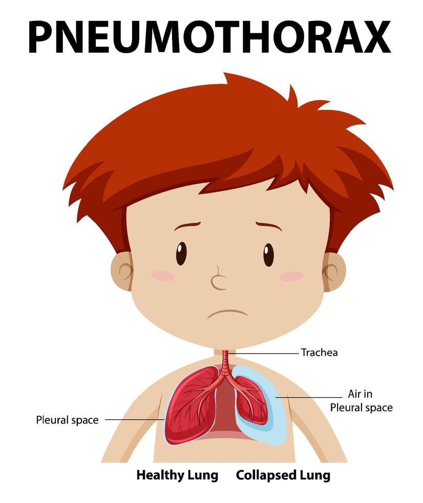 Pneumothorax-Diagramm der menschlichen Anatomie vektor
