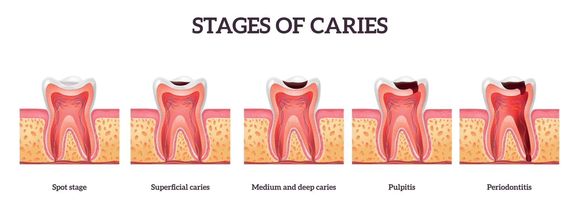 Stadien der Zahnzerstörung vektor