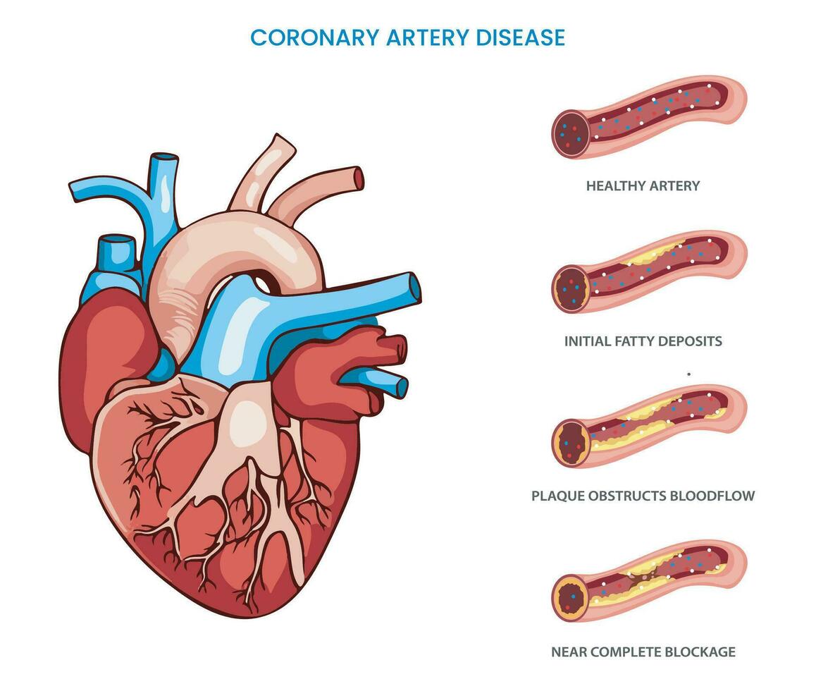 i koronar artär sjukdom hjärta artärer bli smal som nedsatt blod strömma vektor