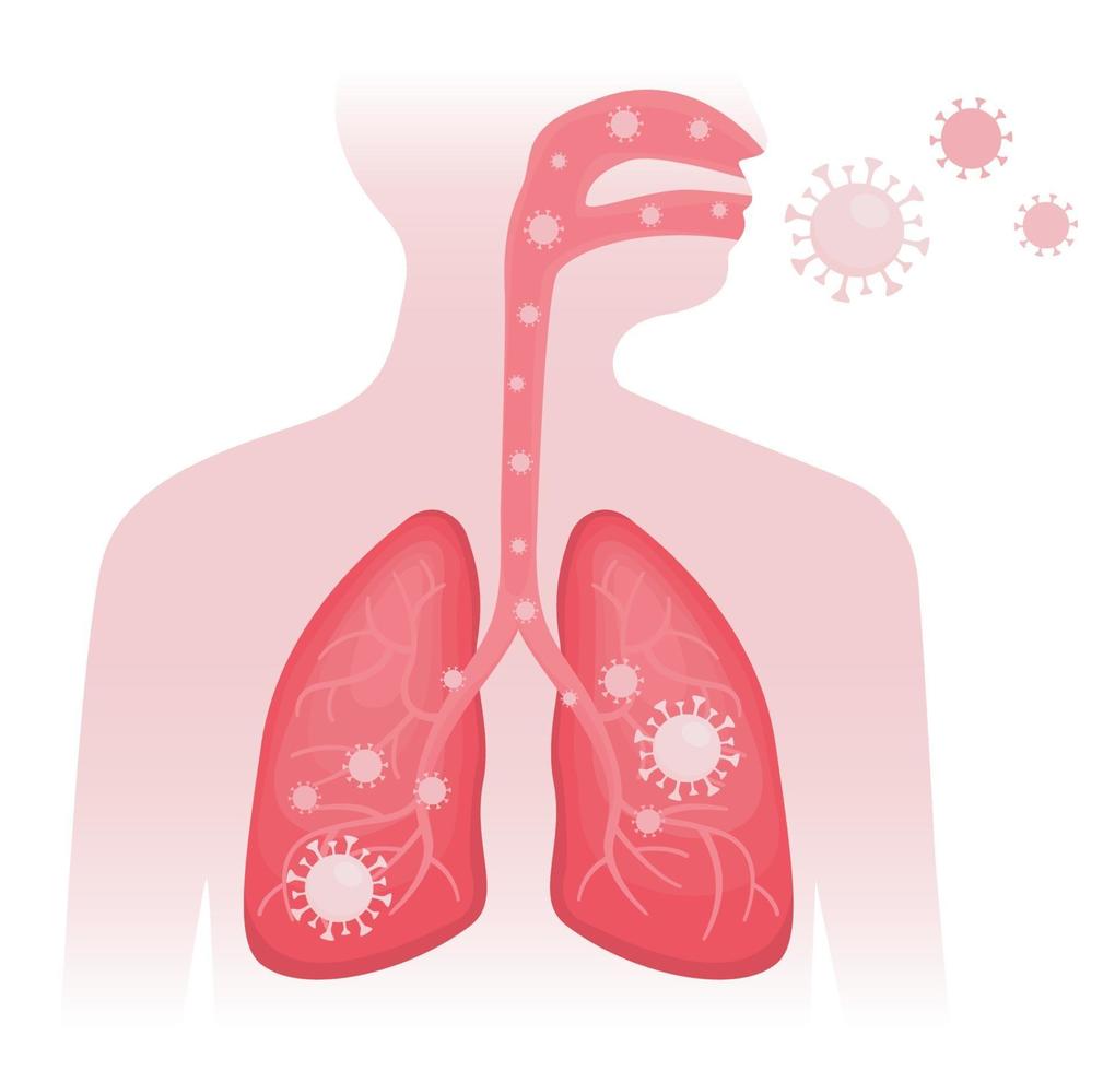 Infizierte Person verbreitet Covid, Virus menschliche Lunge vektor