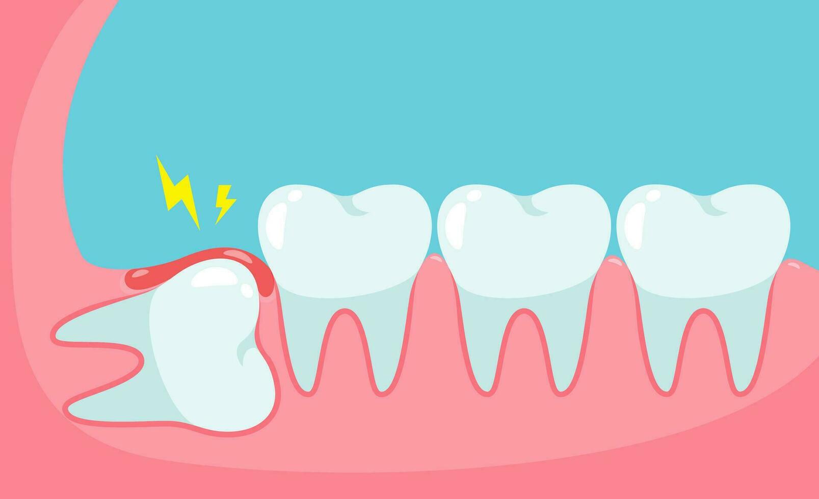 betroffen Weisheit Zahn Ursache Schmerzen im das Mund.Zahnmedizin Pflege Konzept vektor