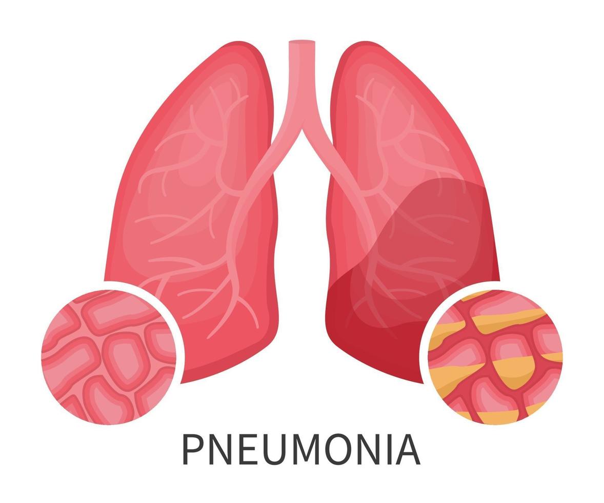 mänskliga lungor som skadas av virus eller lunginflammation vektor