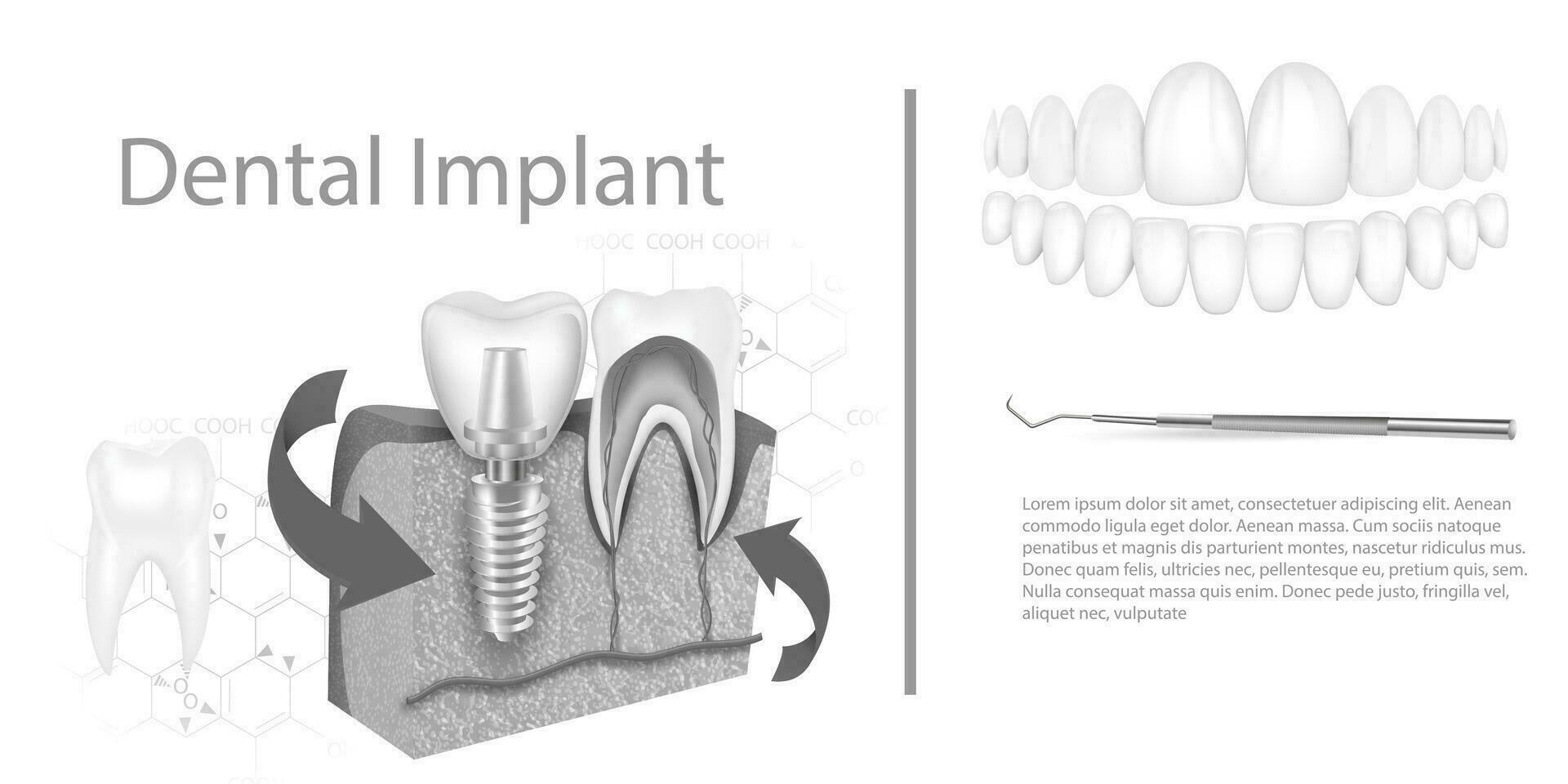 dental implantera strukturera medicinsk illustrerad fostrande infographic affisch med molar- ersättning slutet friska verktyg modeller vektor illustration.