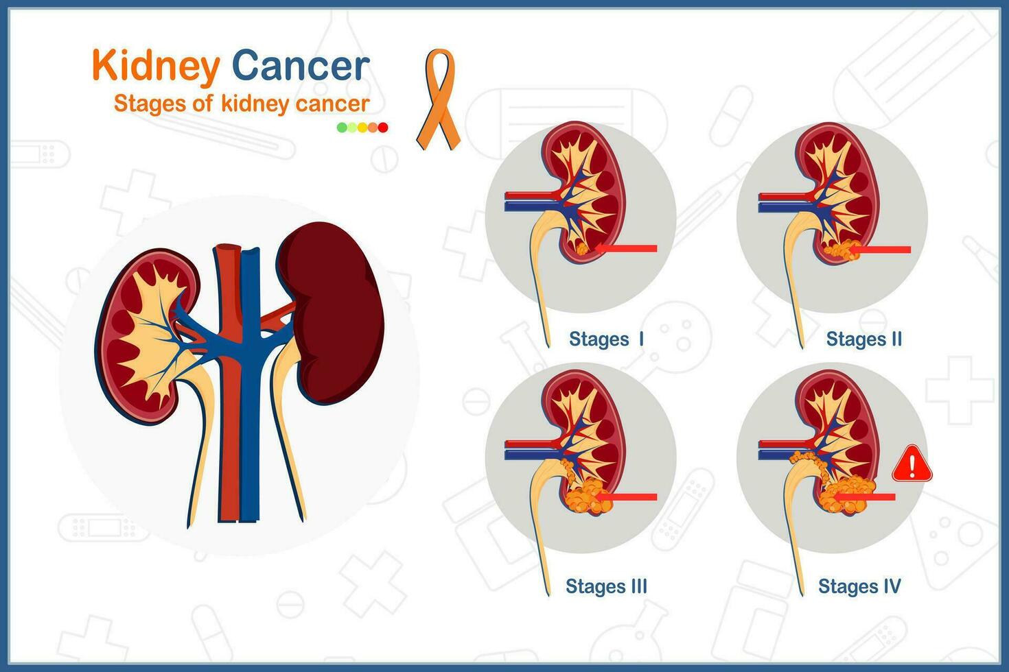 medizinisch Vektor Illustration Konzept im eben Stil von Niere Krebs. 4Stufen von Niere Krebs und Niere Tumor Abbildung.isoliert auf Weiß Hintergrund.