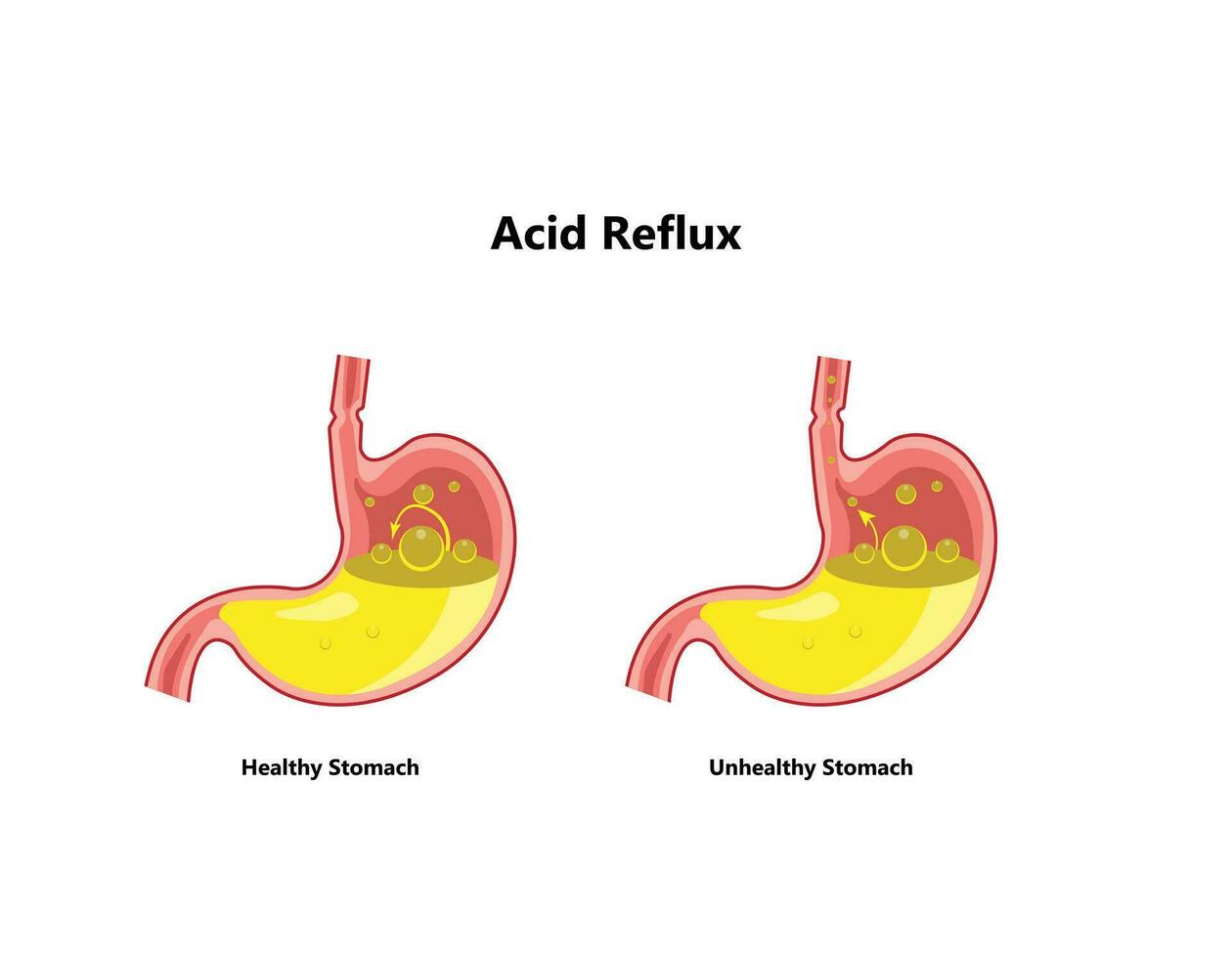 återflöde eller gastroesofageal reflux, halsbränna. mage sjukdom, mage problem sjukdom begrepp. vektor teckning