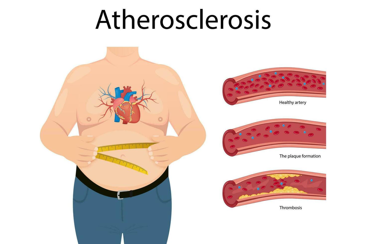 ateroskleros begrepp, hälsa risk. mänsklig hjärta. medicinsk vektor