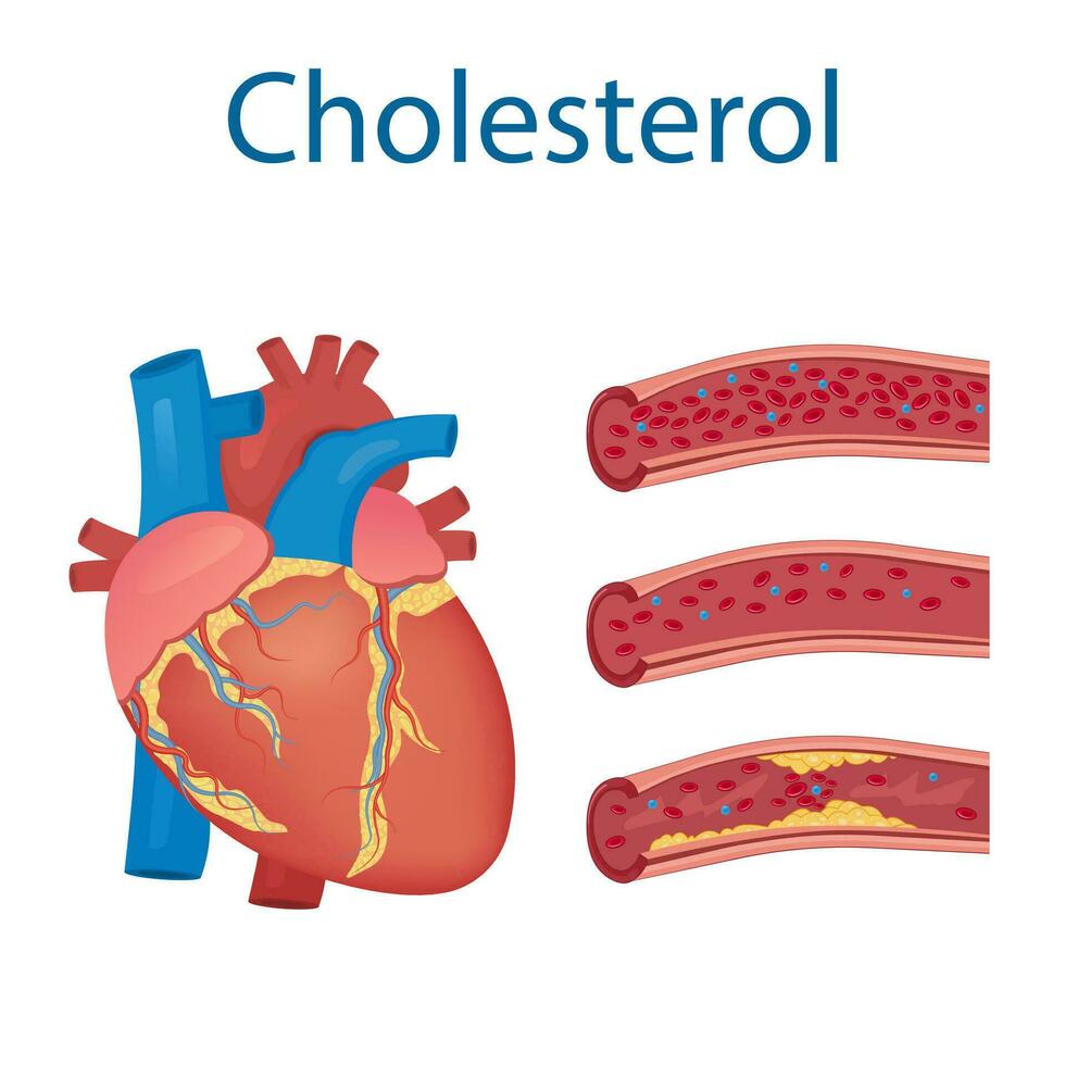 Atherosklerose Konzept, Gesundheit Risiko. Mensch Herz. medizinisch Vektor Illustration