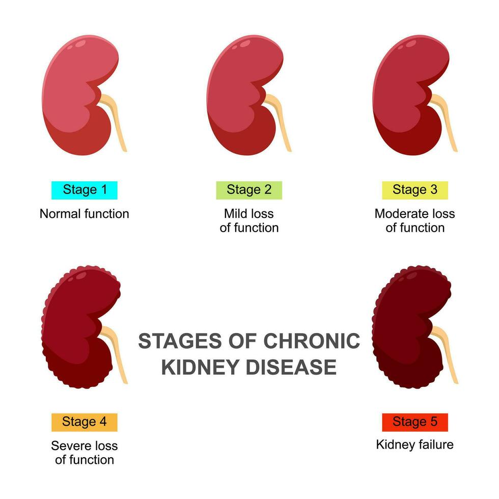 Stufen von chronisch Niere Krankheit. Infografik Konzept Vektor Illustration Problem im Urin- System und normal Niere