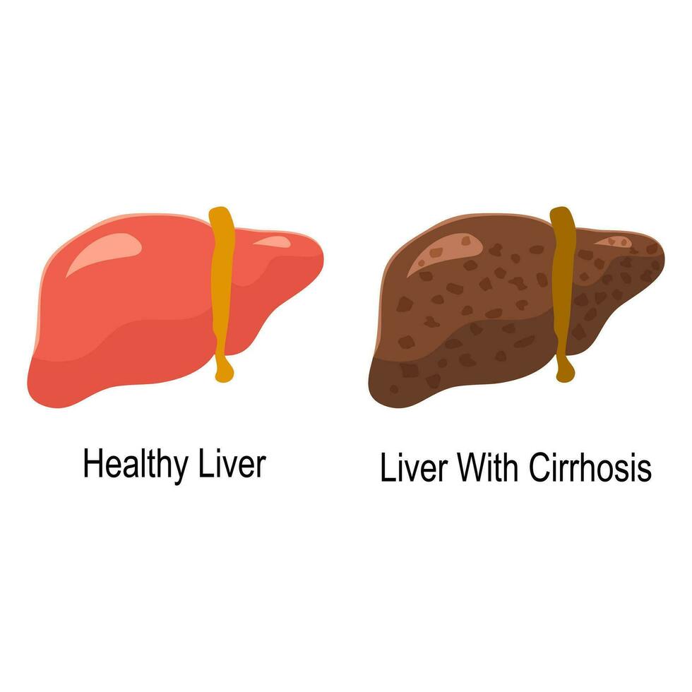 jämförelse av friska lever och lever cirros sjukdom. medicinsk infographic baner vektor