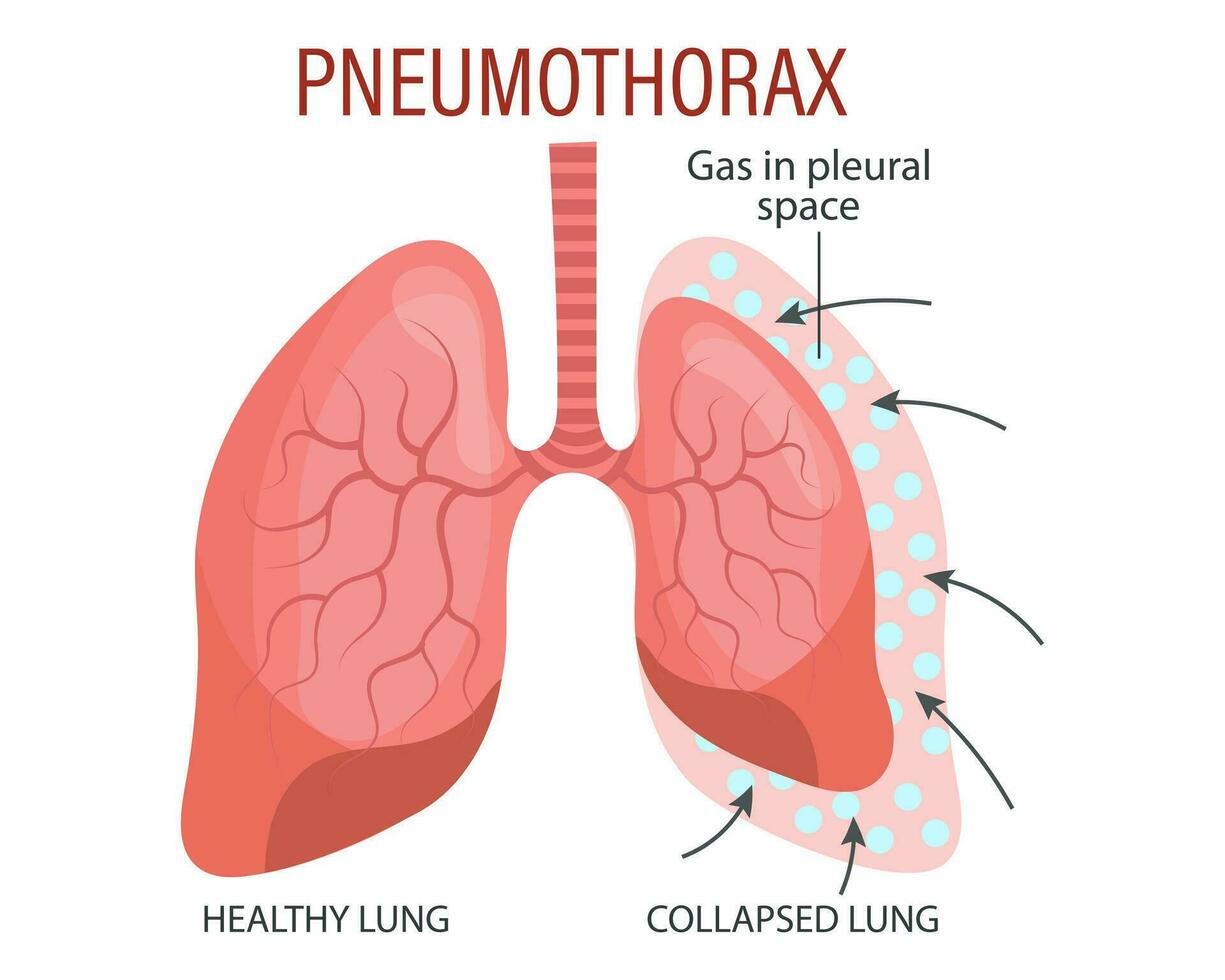 Pneumothorax, ein Lunge Krankheit. Gesundheitspflege. medizinisch Infografik Banner, Illustration, Vektor