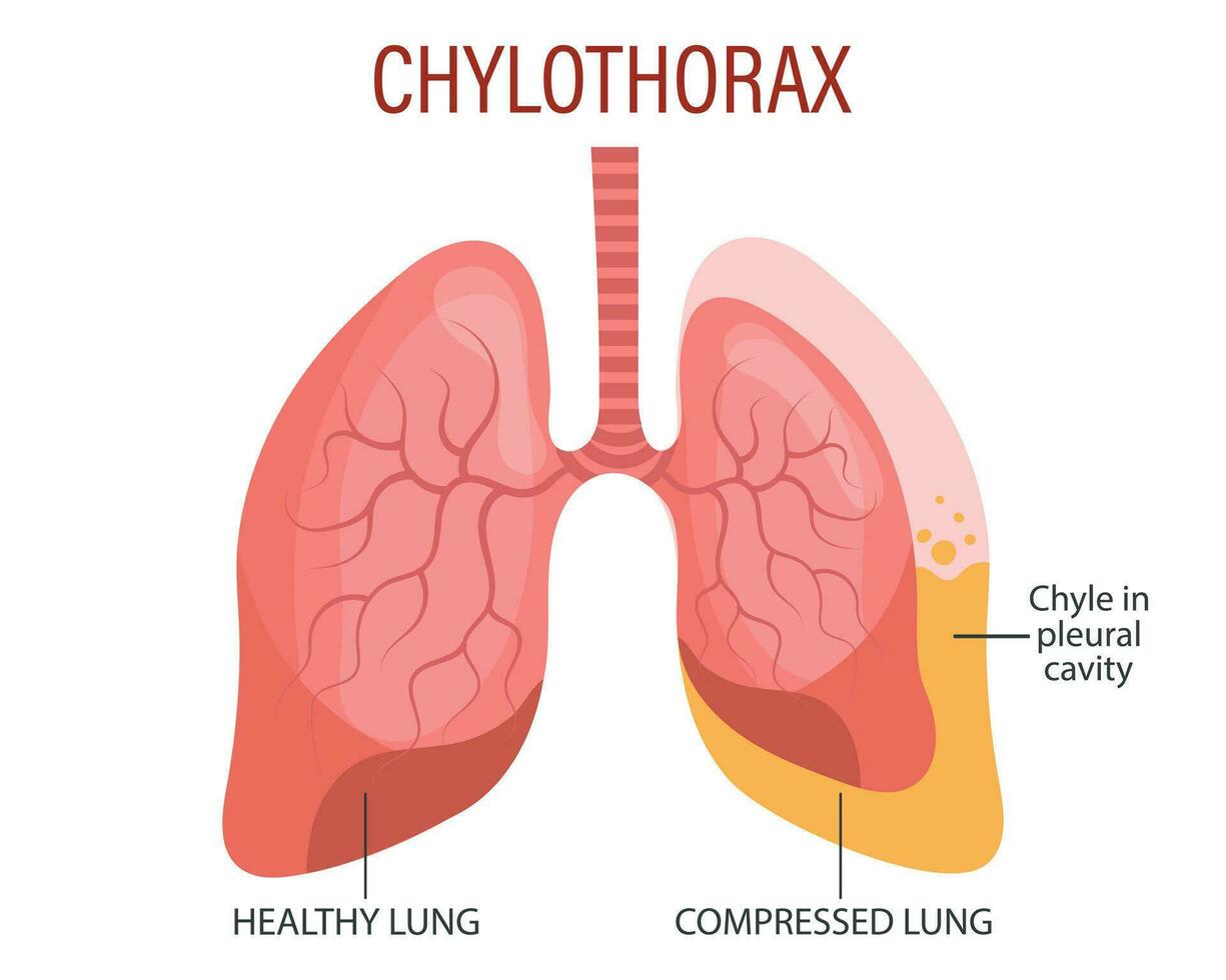 Chylothorax, Lunge Krankheiten. Gesundheitspflege. medizinisch Infografik Banner, Illustration, Vektor
