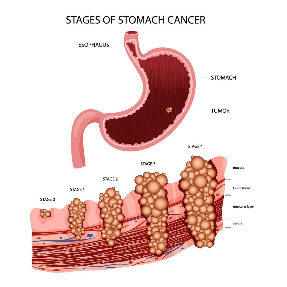 Bauch Krebs. Stufen Wachstum maligne krebsartig Tumor. anatomisch Vektor Illustration isoliert Weiß Hintergrund Karikatur Stil