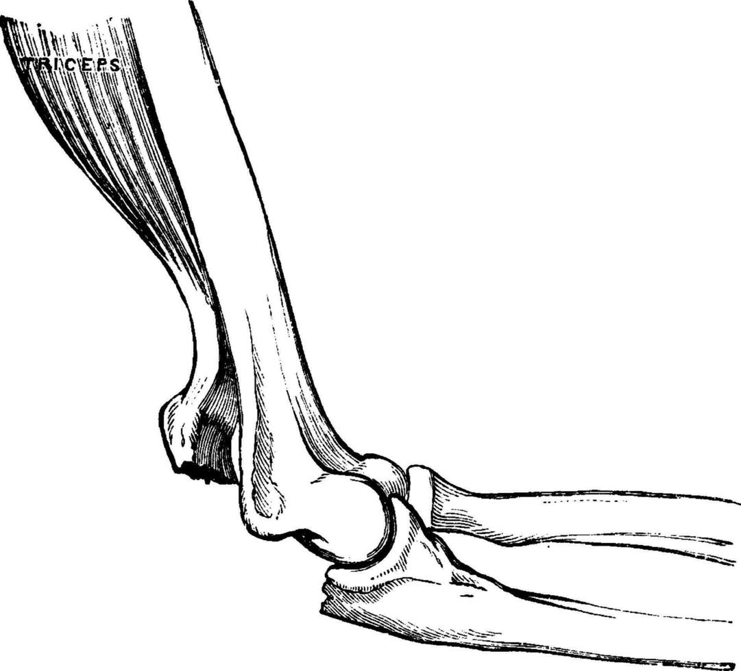 fractured olecranon, årgång illustration. vektor