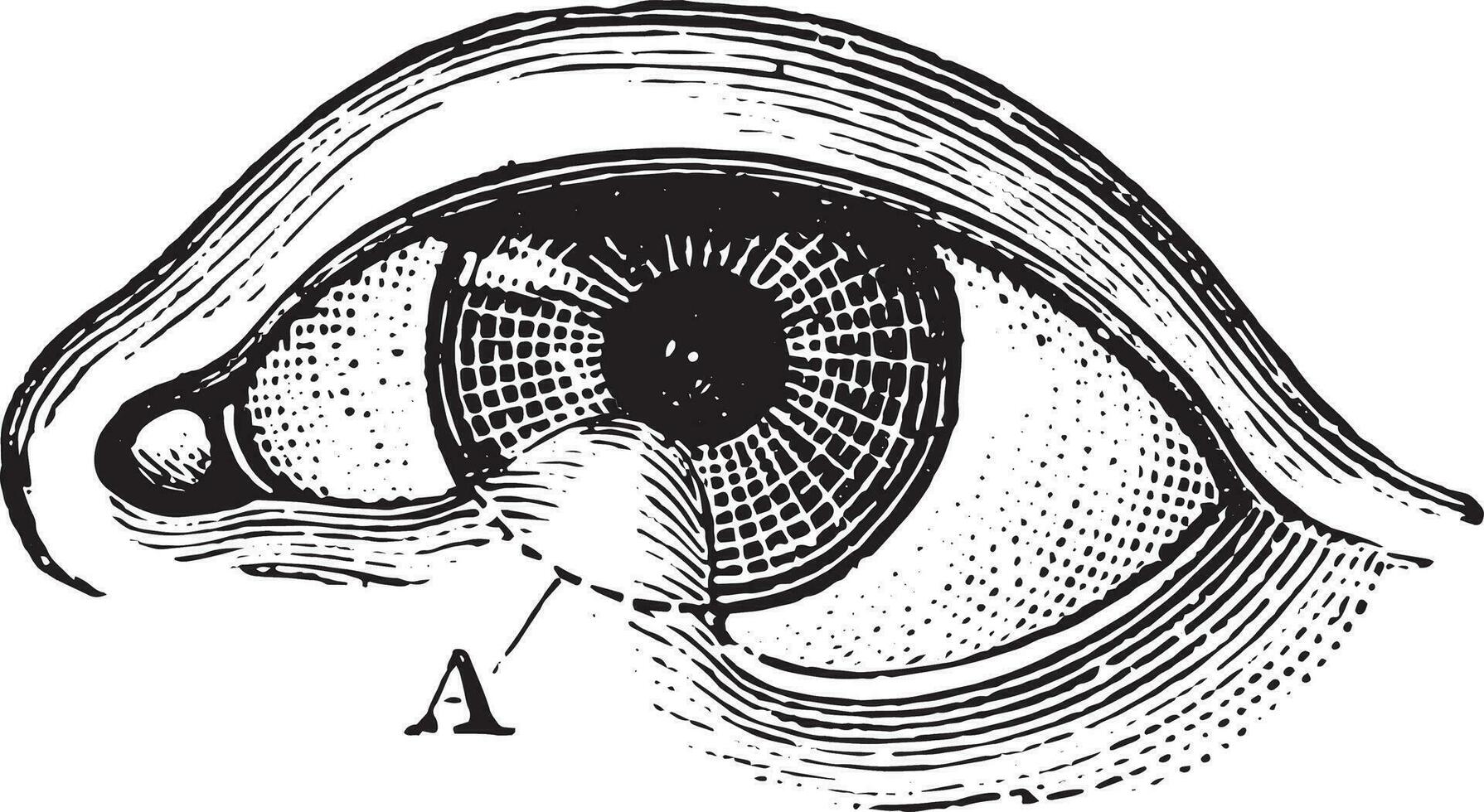 Symblepharon von das niedriger Augenlid, Jahrgang Gravur. vektor