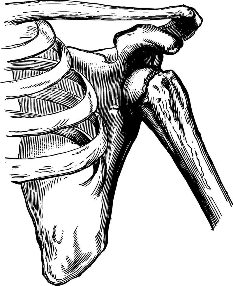 Luxation von das Humerus, Jahrgang Illustration. vektor