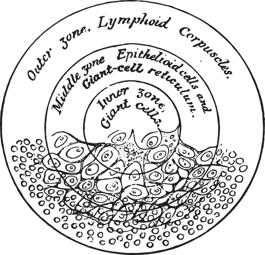 Diagramm von das Struktur von ein Tuberkel, Jahrgang Gravur. vektor