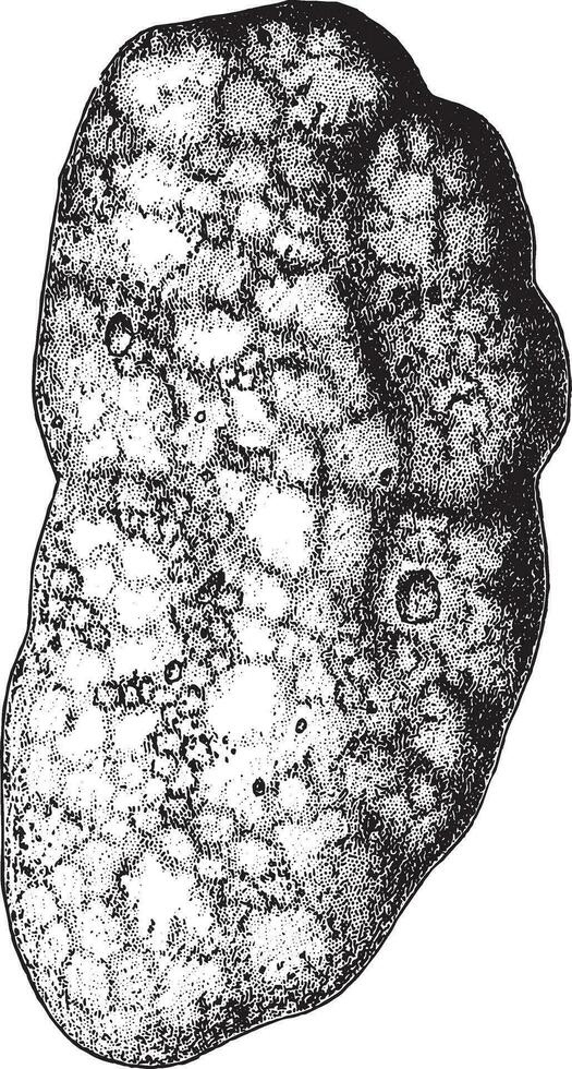 Niere zeigen chronisch interstitial Nephritis, Jahrgang Gravur. vektor