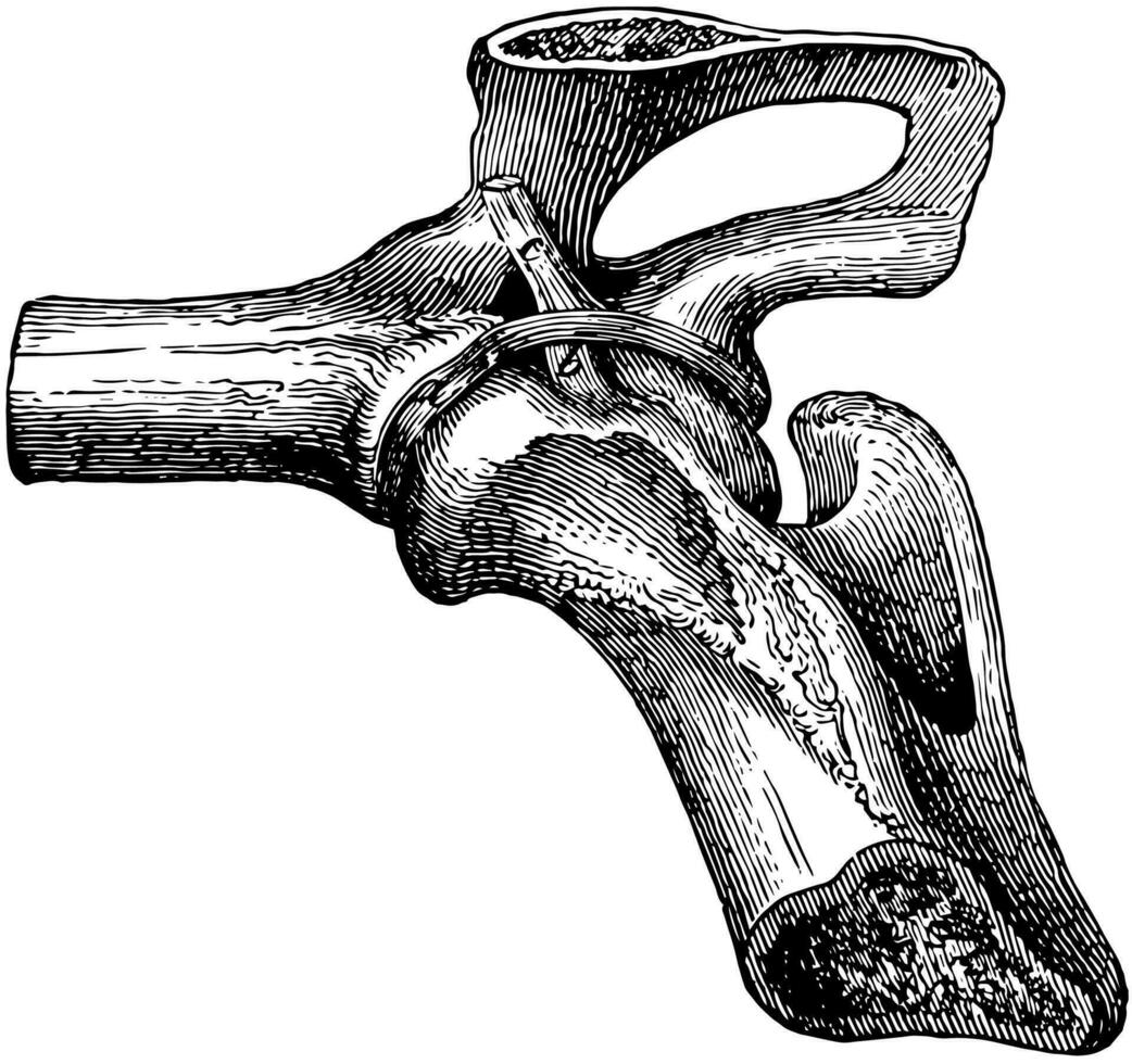 Hüfte Joint Bänder, Jahrgang Illustration. vektor