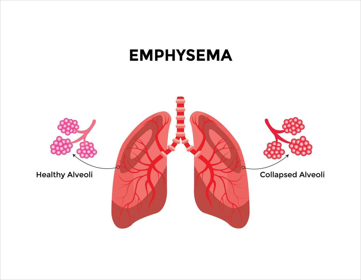 emfysem sjukdom begrepp. skadad alveoler, fel luftvägar. diskett väggar mellan luft säckar i mänsklig lungorna. vektor