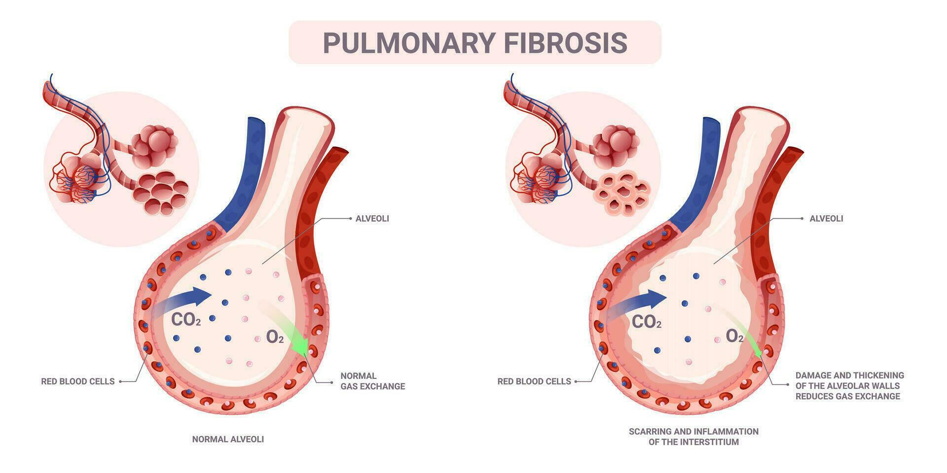 lung- fibros alveolerna anatomi. vektor illustration isolerat på vit bakgrund