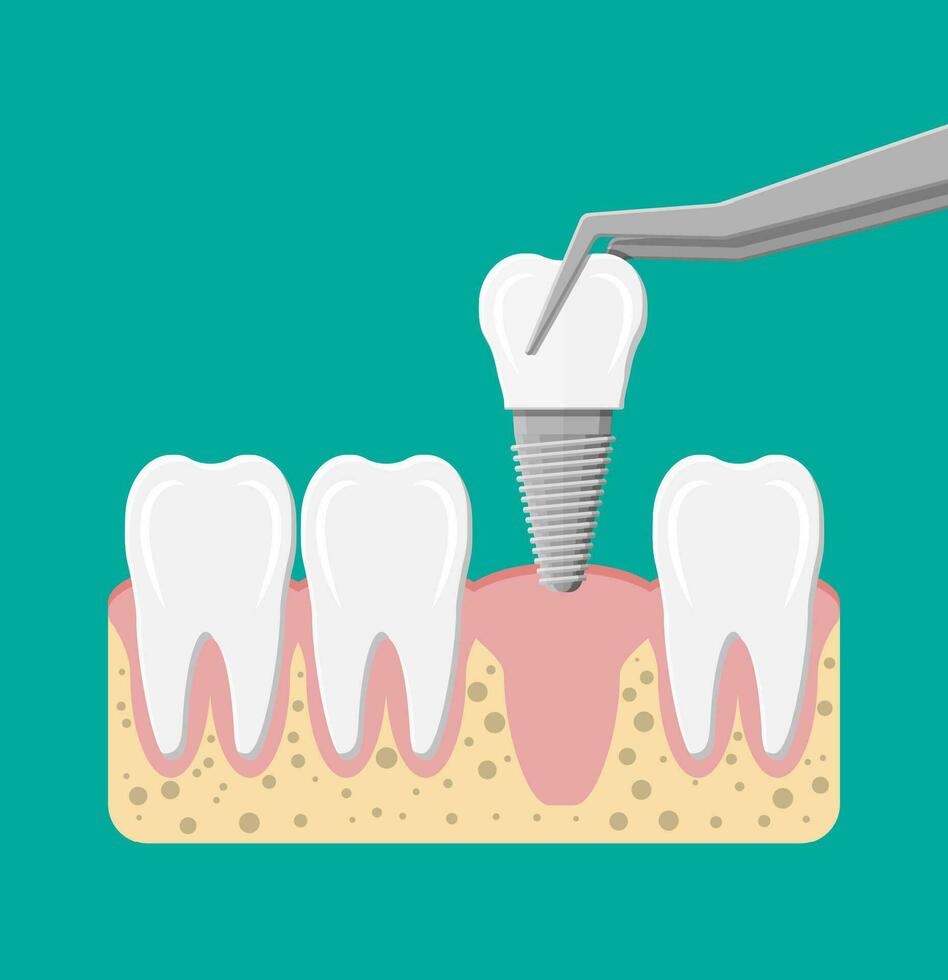 Zahn Wiederherstellung. Installation von das Dental implantieren. Dental Prothesen. künstlich Zähne mit Stahl Stift. Oral Pflege, Stomatologie und Zahnheilkunde. Vektor Illustration im eben Stil