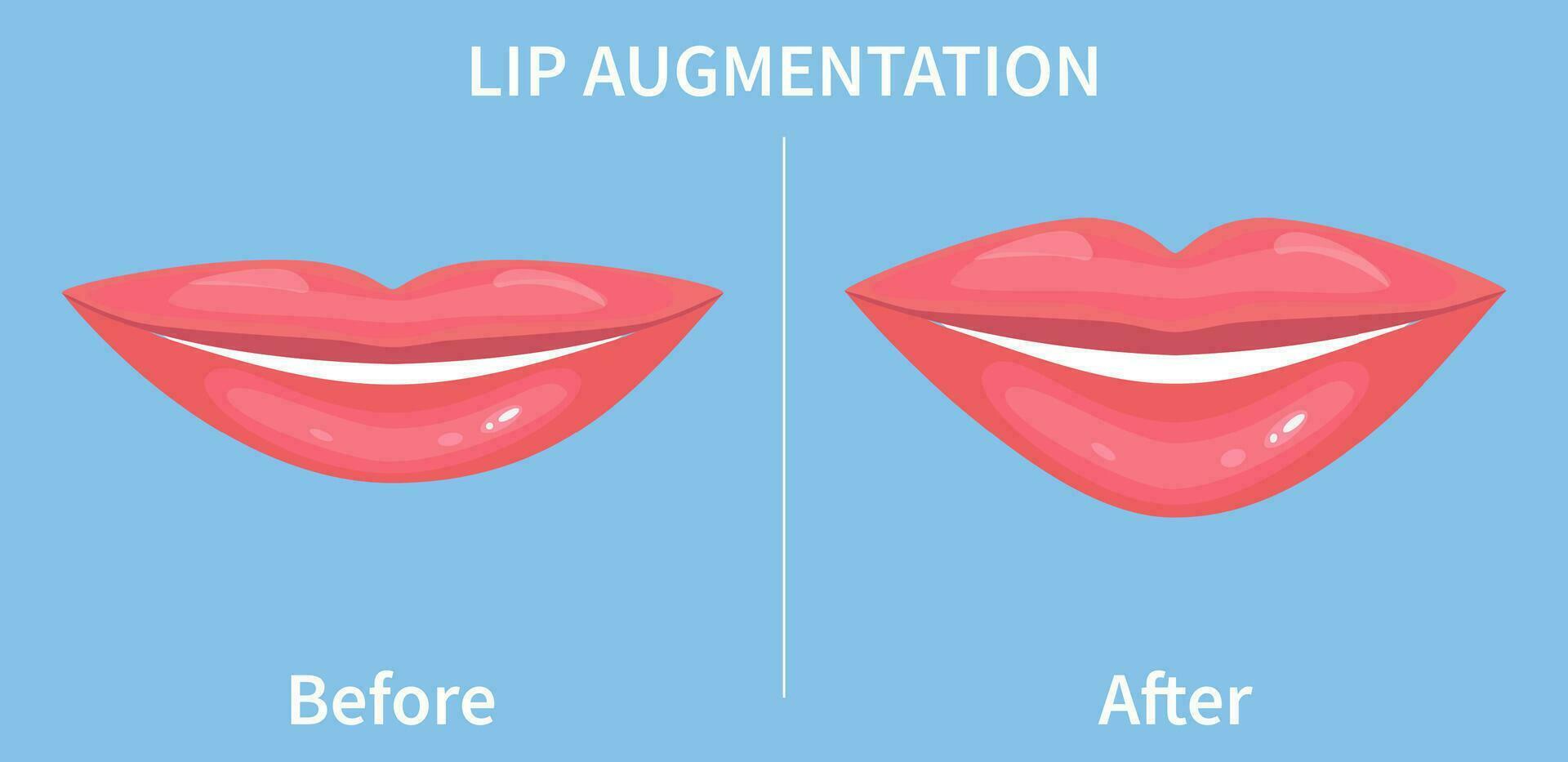 Lippe Augmentation. Vor und nach Lippe Füllstoff Injektionen. hyaluronic Acid Injektionen. Vektor Illustration im eben Stil