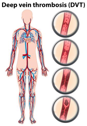 Anatomie der tiefen Venenthrombose vektor