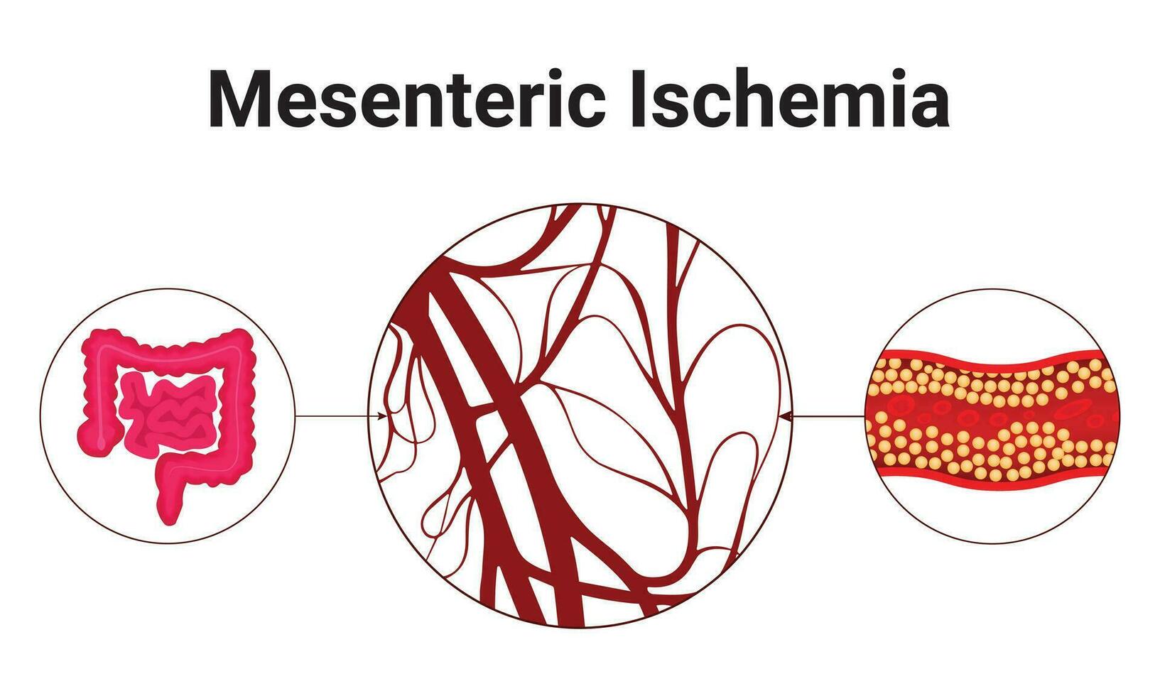 mesenterisk ischemi vetenskap design vektor illustration diagram