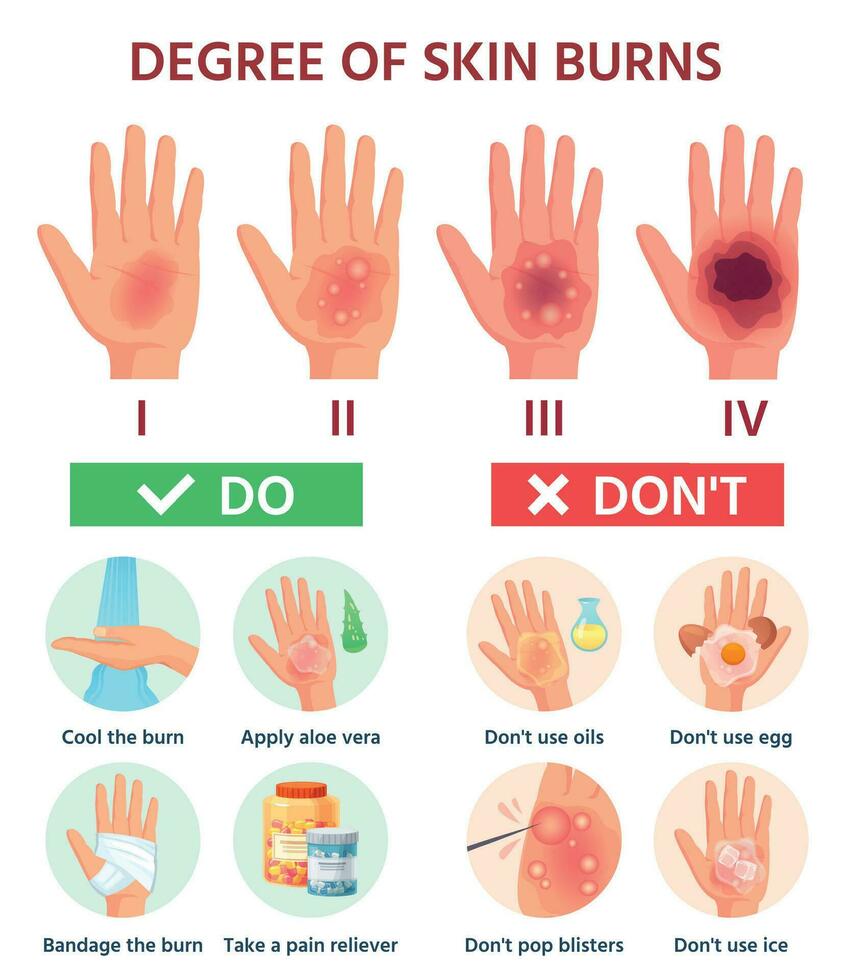 brennt Grad. zuerst Hilfe zum brennen Wunde. Feuer Beschädigung zu Haut Einstufung. Hand Blasen. Vektor Infografik Behandlung zum Thermal- Wunde