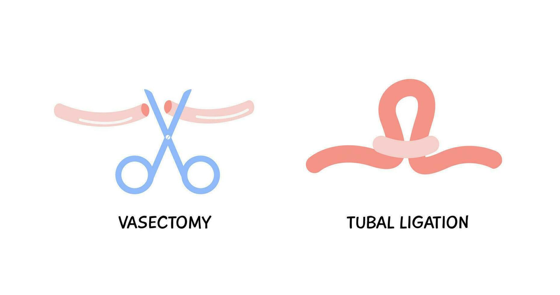 Vasektomie. männlich oder weiblich Sterilisation Konzept. Tuben Ligation farbig eben Stil Symbol. Frauen oder Mann chirurgisch permanent Geburt Steuerung Methoden. Chirurgie Verfahren. Vektor Element isoliert auf Weiß.