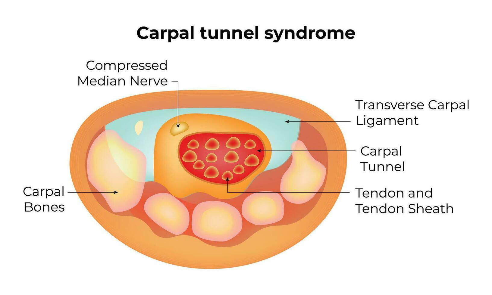 Karpal Tunnel Syndrom Wissenschaft Design Vektor Illustration Diagramm