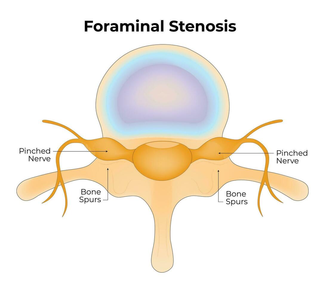 foraminal Stenose Wissenschaft Design Vektor Illustration