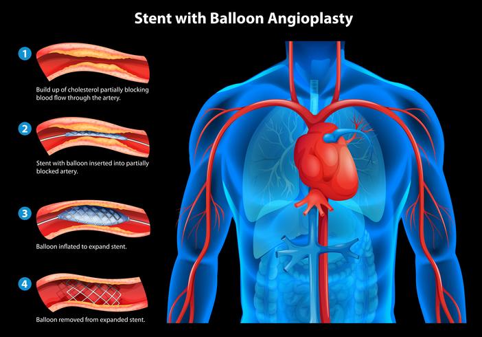 Stent mit Ballonangioplastie vektor