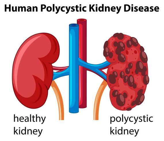 Diagram som visar mänsklig polycystisk njursjukdom vektor
