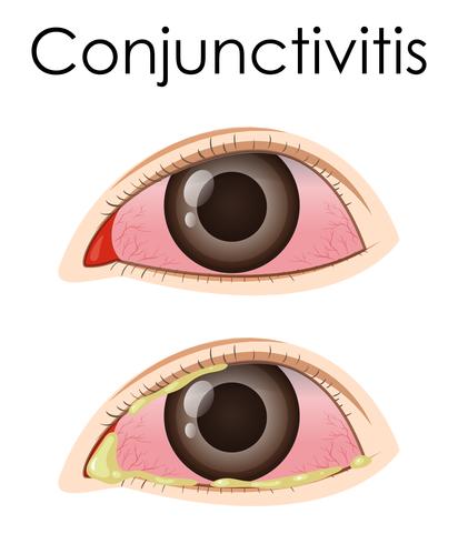 Diagram som visar konjunktivit i människa vektor