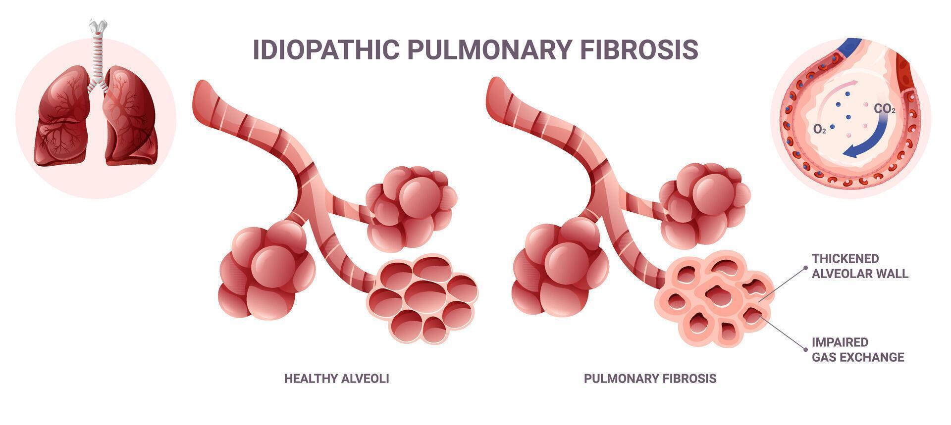 idiopathisch Lungen Fibrose Infografik. Vektor Illustration isoliert auf Weiß Hintergrund