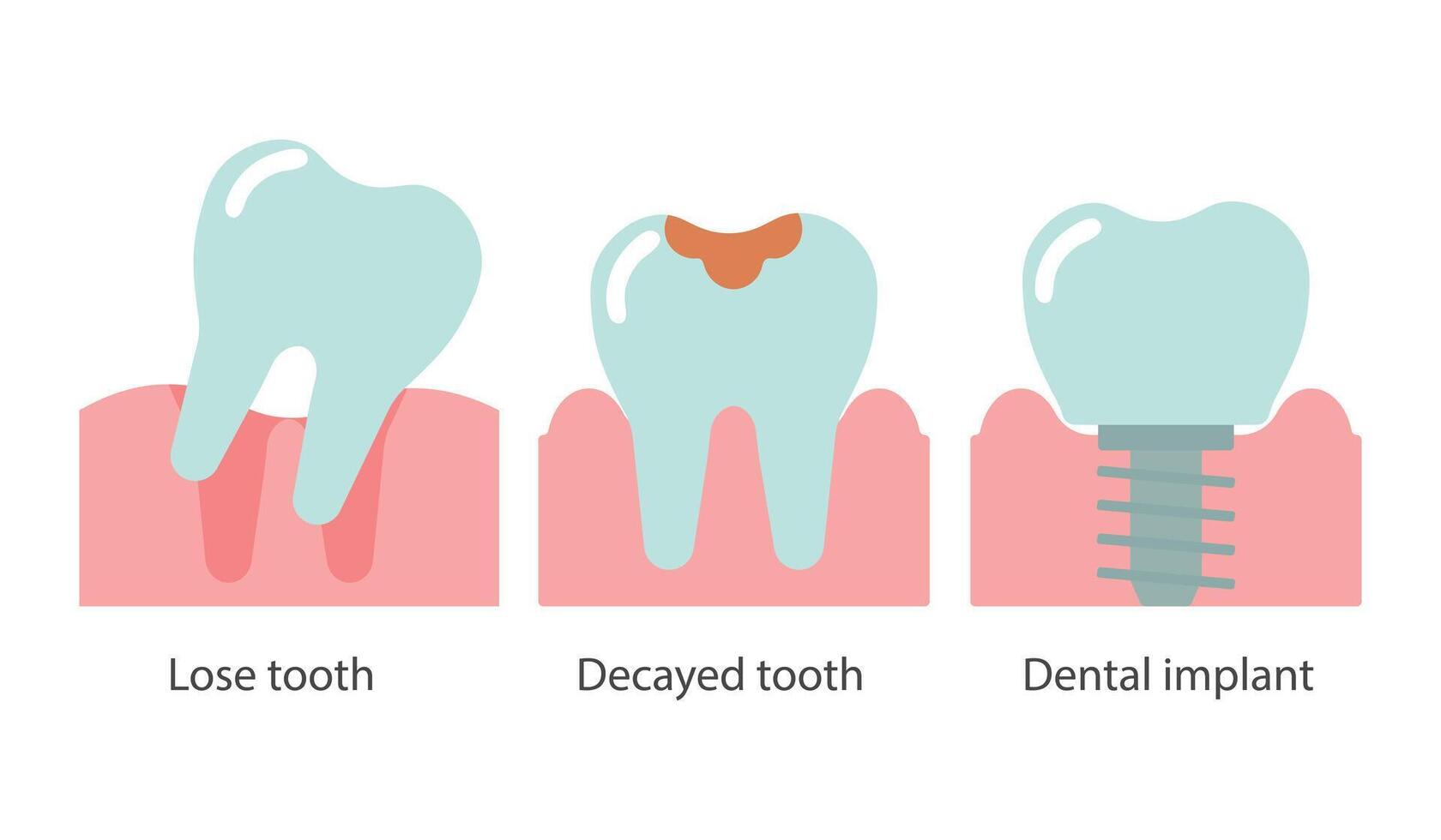 tandvård, ikoner uppsättning. förlorat tand, förfallen tand, implantera. medicinsk begrepp. vektor