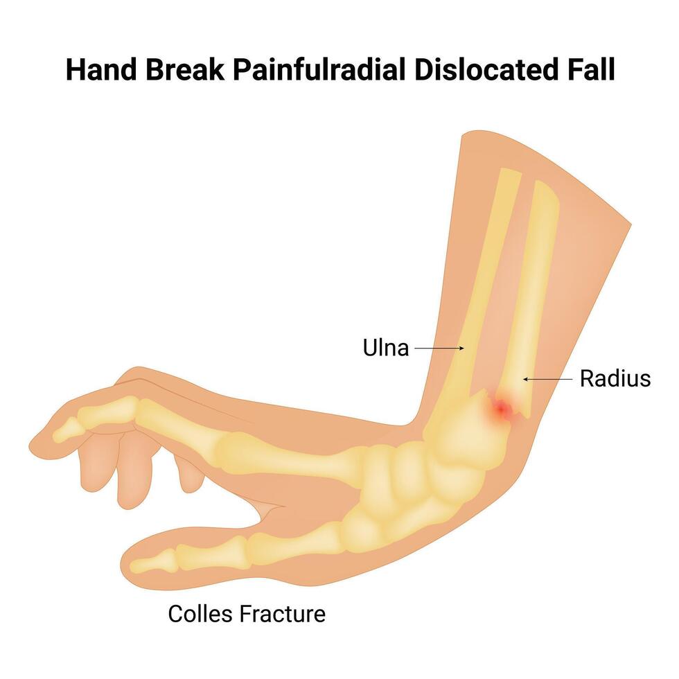 Hand brechen schmerzhaftradial ausgerenkt fallen Wissenschaft Design Vektor Illustration