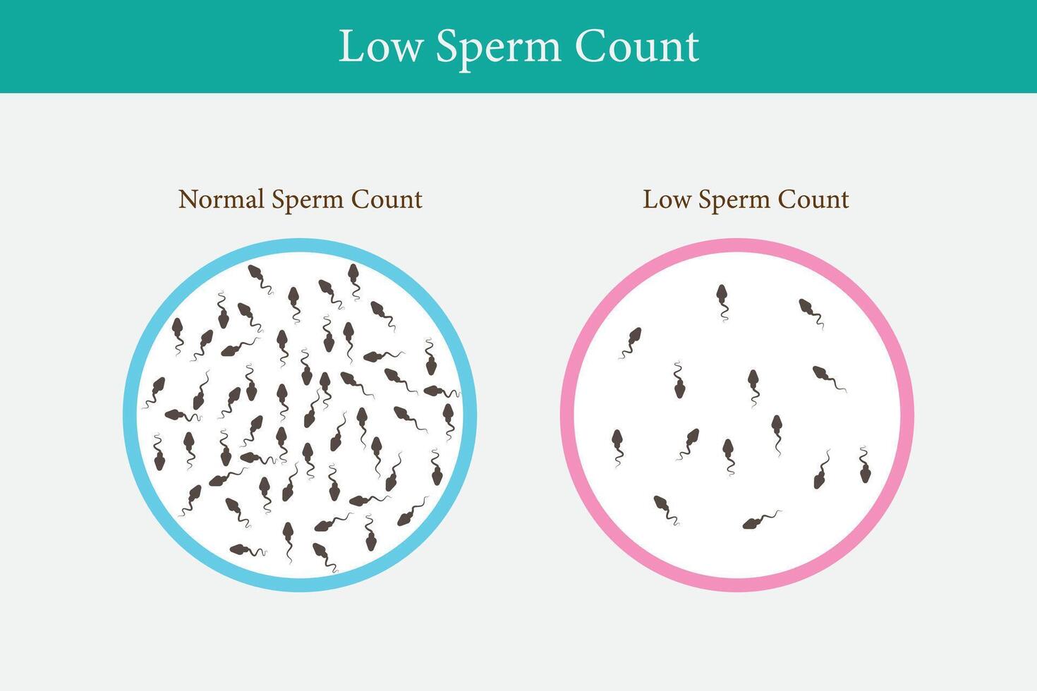 normal und niedrig Sperma Anzahl Illustration. männlich Unfruchtbarkeit Oligospermie. Struktur von das Sperma. Vektor. eps 10 vektor