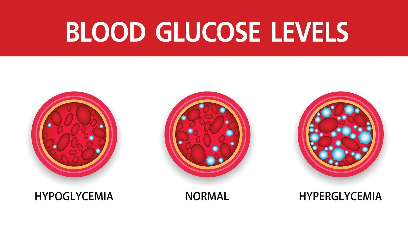 hyperglykemi, högt blodsocker och diabetes, fetma är ett allvarligt medicinskt tillstånd orsakar, vektordesign. vektor