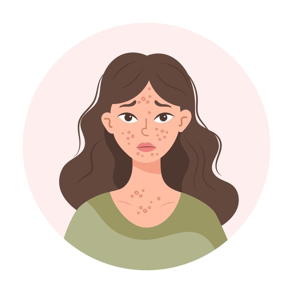 acne. olycklig Tonårs flicka med acne och finnar på henne ansikte. irriterad ansiktsbehandling hud. illustration, vektor