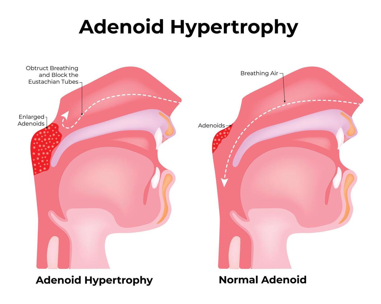 adenoid hypertrofi vetenskap design vektor illustration diagram