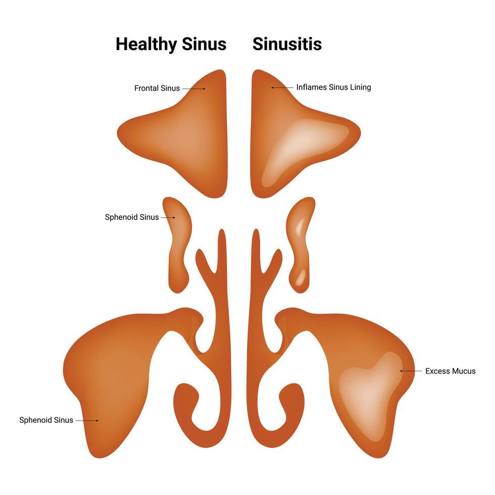 friska sinus bihåleinflammation vetenskap design vektor illustration diagram