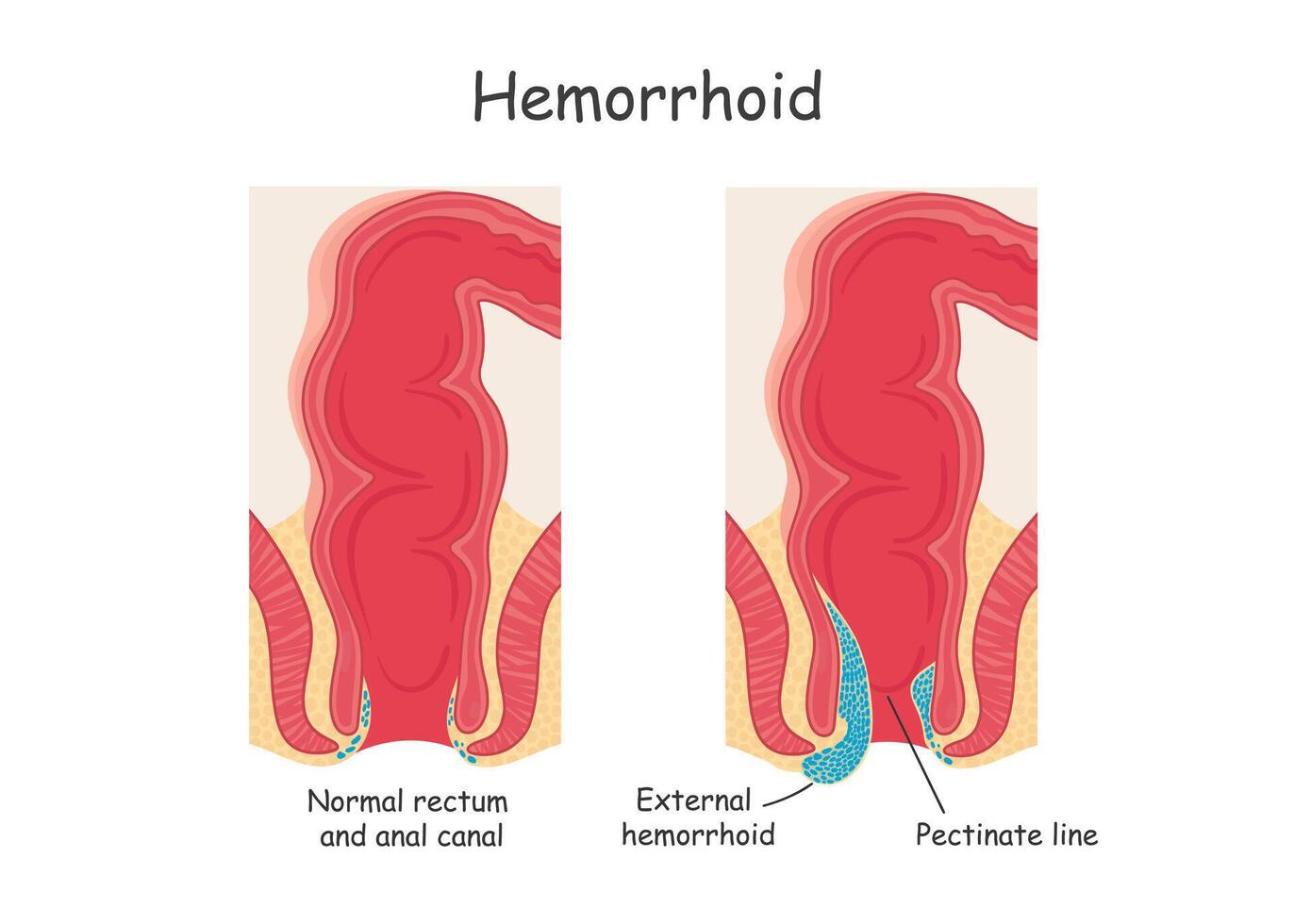 Hämorrhoiden im das Rektum. Vektor Illustration im Karikatur Stil.