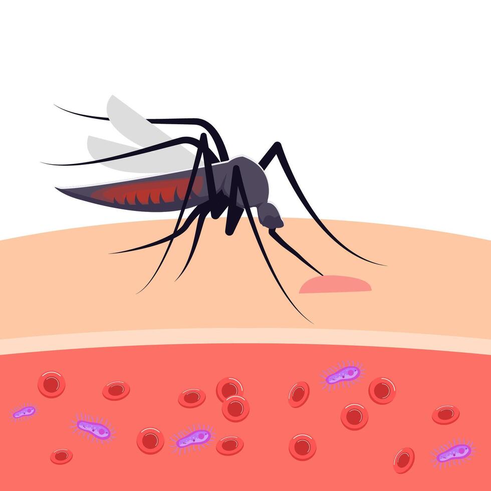 Illustration Mücken beißen das Haut und Infektion Parasiten vektor